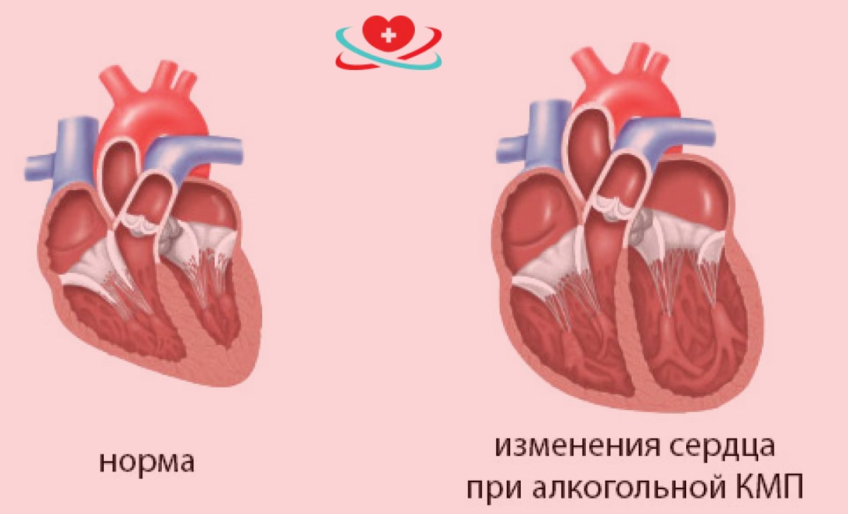 Сравнение сердец при кардиомиопатии